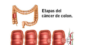 Cáncer de colon