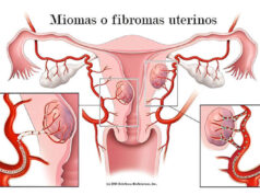 Cómo deshacerte de los miomas y quistes de forma natural miomas y quistes