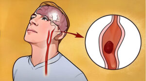 Los síntomas tempranos de un derrame cerebral que debes conocer