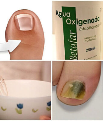 remedio para pies y uñas