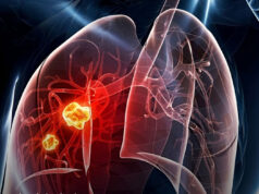 Señales silenciosas: síntomas iniciales del cáncer de pulmón cáncer de pulmón