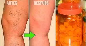 varices eliminar
