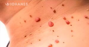 ELIMINA VERRUGAS, LUNARES, FIBROMAS