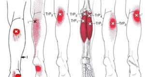 LA FIBROMIALGIA
