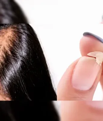 uñas y pelo fragil
